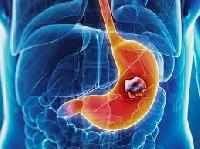 Дефіцит вітаміну В12 пов’язаний із п’ятикратним збільшенням ризику раку шлунка